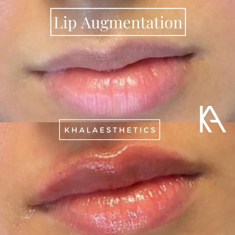 lip-augmentation