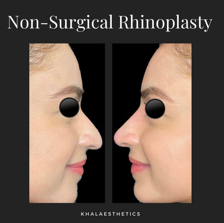 non-surgical-rhinoplasty